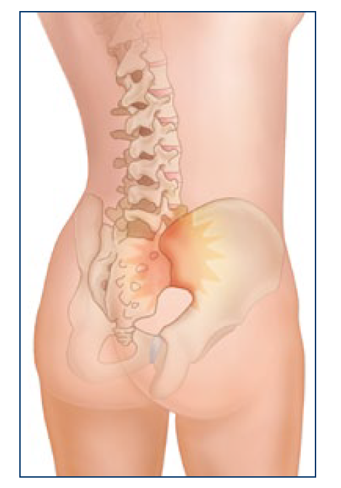 si-joint-pain