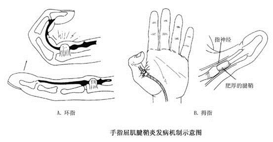 手指腱鞘炎