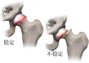 股骨頭壞死的發生有骨內骨外因素