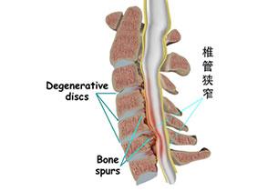 腰椎管狹窄的常見病因有哪些