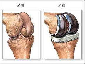 什么情況下需要做人工關節置換