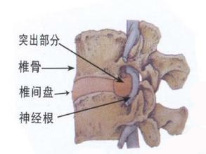 腰間盤突出