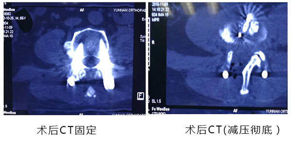 一次手術，幾根釘棒撐起老人幸福晚年 (2)