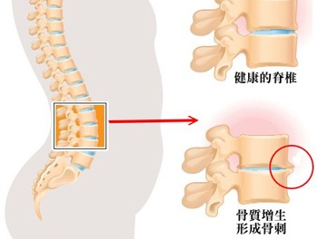 骨刺的形成