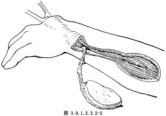 皮瓣移植術