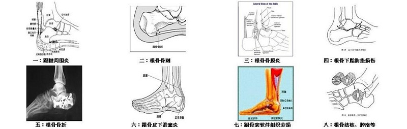 足跟痛