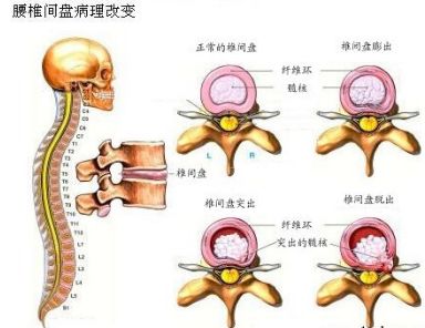 腰椎間盤病理改變