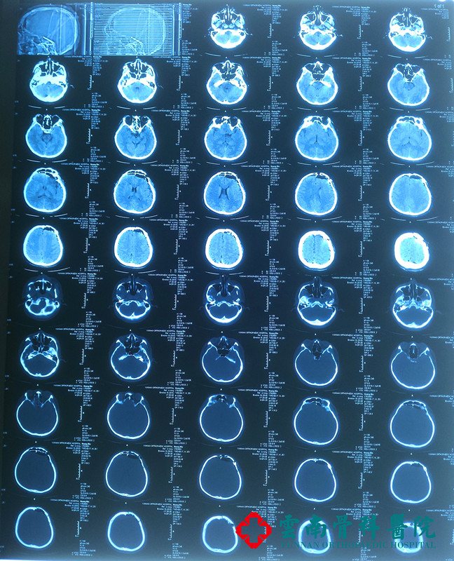 患者頭部CT影像