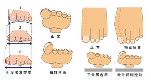 拇外翻是怎樣產生的？