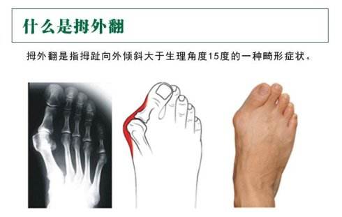 大腳骨的形成原因有哪些