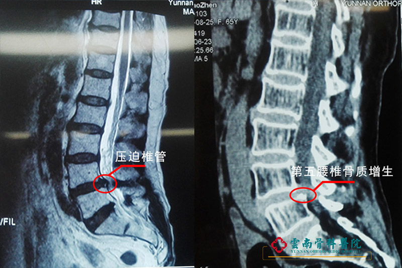 65歲老人腰椎滑脫腰痛難忍，釘棒內固定植骨融合解決腰椎大問題