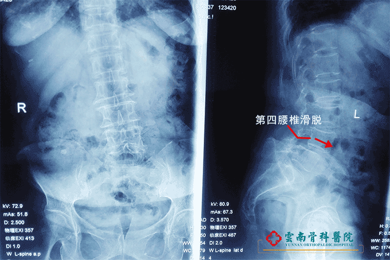 65歲老人腰椎滑脫腰痛難忍，釘棒內固定植骨融合解決腰椎大問題