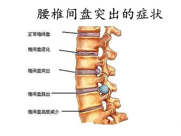 腰椎3