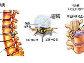 腰椎間盤突出體征