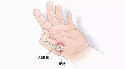 兒童先天性腱鞘炎2